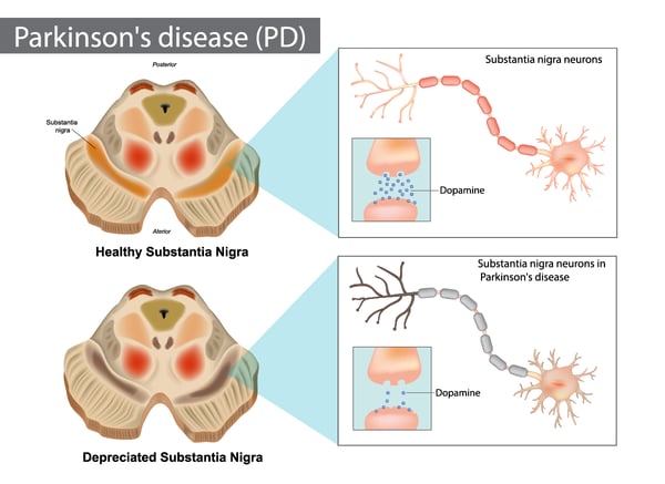 Fig. 3: Parkinson’s disease - Normal and depreciated substantia nigra.