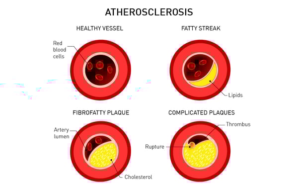 Fig. 1: Fatty plaques in heart arteries (atherosclerosis) hinder blood supply of the heart and lead to coronary heart disease.