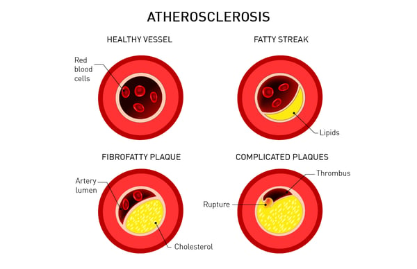 Fig. 1: Fatty plaques in heart arteries (atherosclerosis) hinder blood supply of the heart and lead to coronary heart disease.