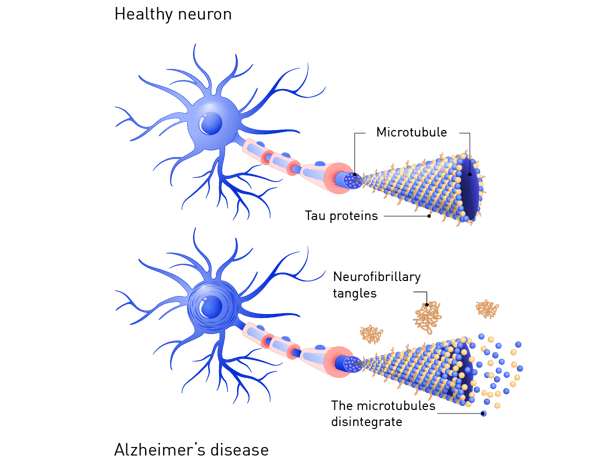 Fig. 1: The tau hypothesis in Alzheimer’s disease.