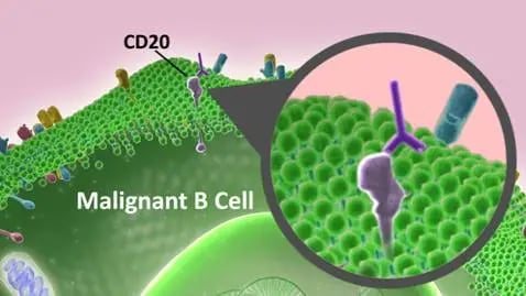 Fig. 1: Example: Rituxan® (rituximab) Rituxan® (rituximab) isi a good example of a monoclonal antibody that can activate the immune system to attack a cancer cell. It binds to a surface protein, called CD20, located on mature B lymphocytes (B cells). Once bound, the antibody activates the body's immune system, which then attacks the cancer cells. Rituxan® (rituximab) may also make cells more susceptible to chemotherapy, promoting more cell death by apoptosis. Because CD20 is on all B cells, Rituxan® (rituximab) kills normal as well as cancer cells. However, patients can regenerate normal B cells from their own or transplanted blood stem cells.
