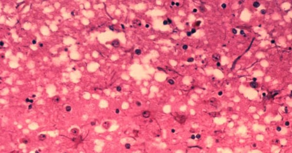 Fig. 1: Brain histology of a cow affected by mad cow disease (bovine spongiform encephalopathy, BSE). Prion protein aggregates cause neuronal death and vacuole formation, giving the brain a sponge-like (spongiform) appearance. Source: Public Health Image Library, APHIS: http://www.aphis.usda.gov/lpa/issues/bse/bse_photogallery.html