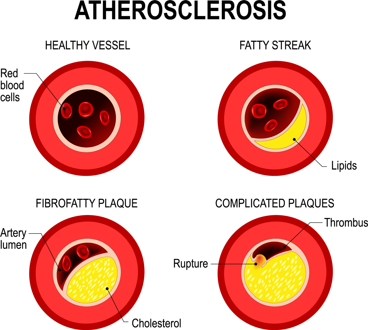 Fig. 1: Fatty Plaques in heart arteries (atherosclerosis) hinder bloody supply of the heart and lead to coronary heart disease.