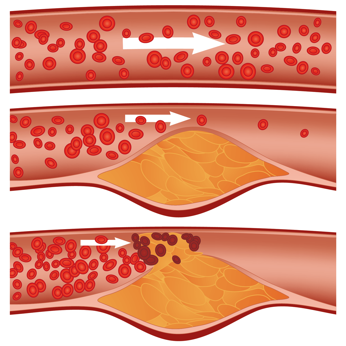 Fig. 1: Vascular occlusion: schematic of cholesterol plaque in artery (atherosclerosis) leading to ischemia.