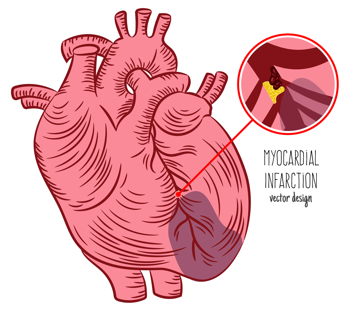 Fig. 2: Myocardial ischemia is the deprivation of oxygen and nutrients in the heart tissue typically caused by coronary occlusion.