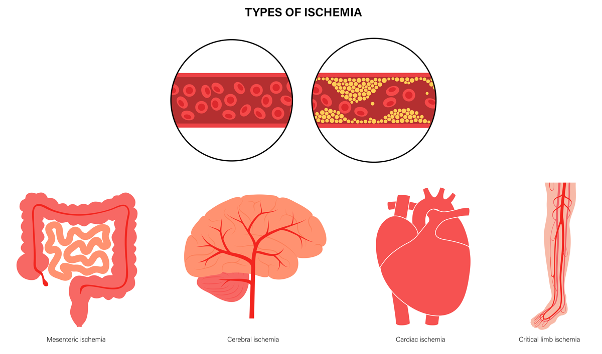 Fig. 3: Organs affected by ischemic injury include heart, intestine, brain limbs, kidney, among others.
